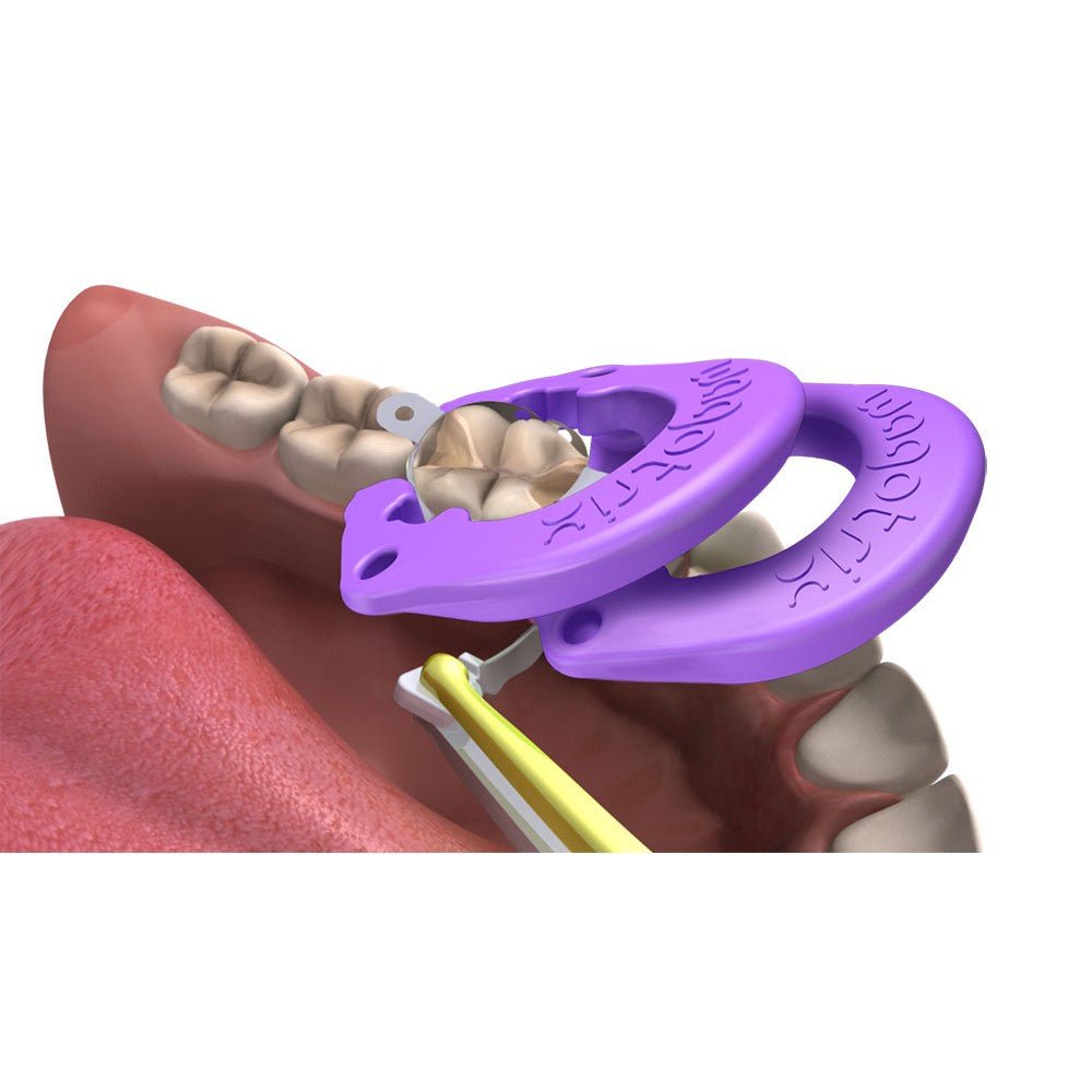 WagoTrix Sectional Matrix Intro Kit Purple Single-Use Matrix Rings - WagoTrix - GoldenDent (view 5)