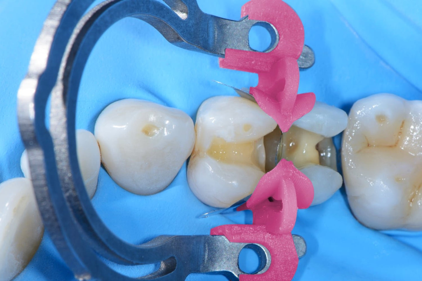 Polydentia myQuickmat Prime Kit - Polydentia - GoldenDent