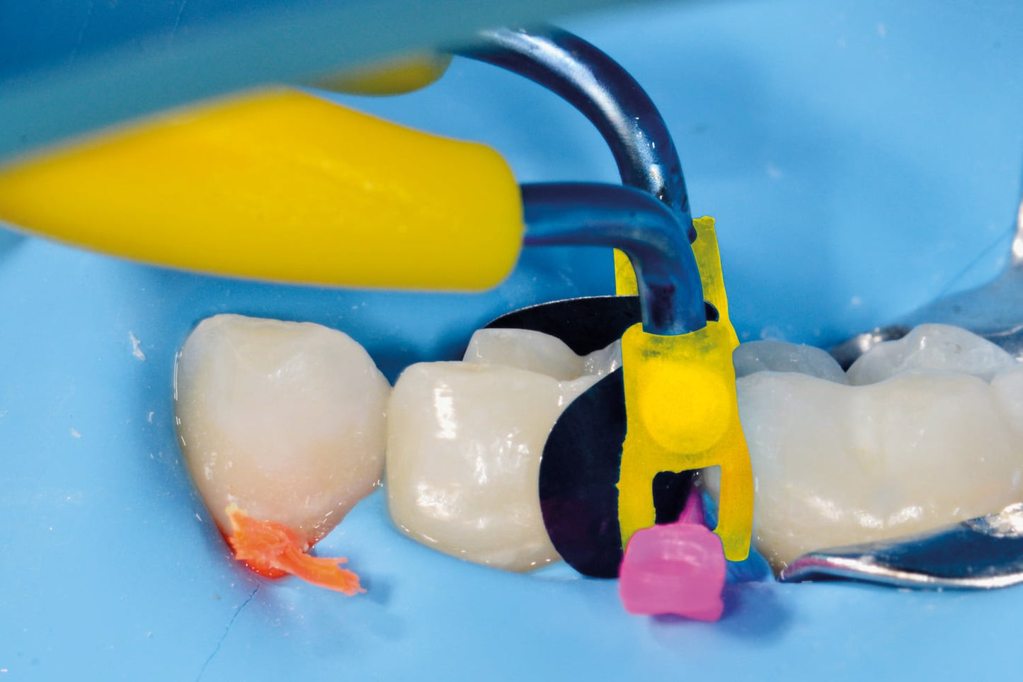 Polydentia myJunior Kit - Pediatric Dentistry Sectional Matrix Kit