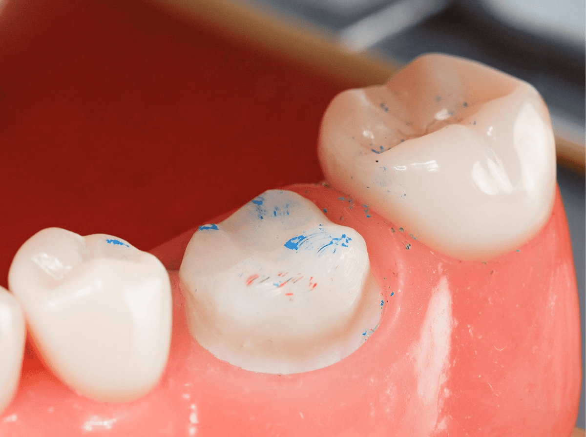 PrepCheck Crown Prep Marking Tabs - Common Sense Dental - GoldenDent