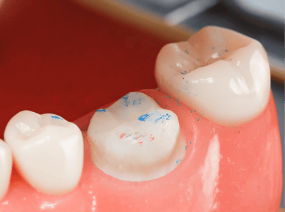 PrepCheck Crown Prep Marking Tabs - Common Sense Dental - GoldenDent