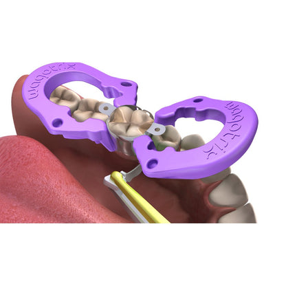 WagoTrix Sectional Matrix Intro Kit Purple Single-Use Matrix Rings
